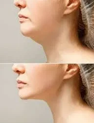 Eliminar papada: armonización del perfil con medicina estética avanzada